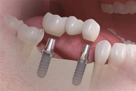 Ponte Fixa Sobre Implantes Kb Implante Dent Rio E Pr Tese Dent Ria