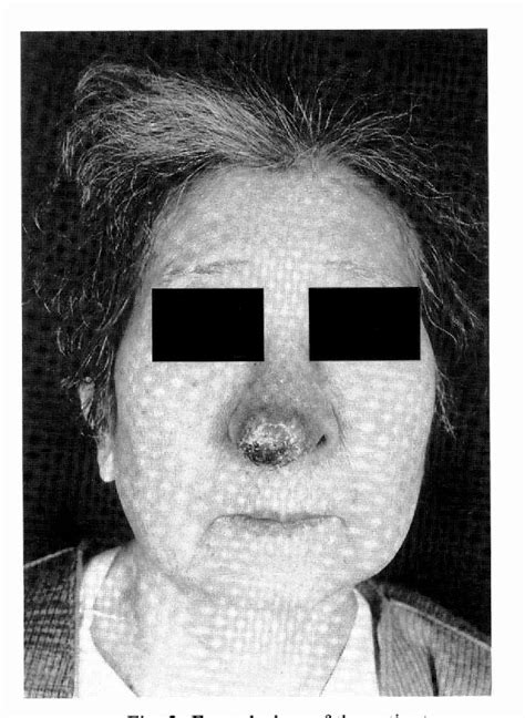 Figure From A Metastasis To The Nasal Tip From A Cervical Carcinoma