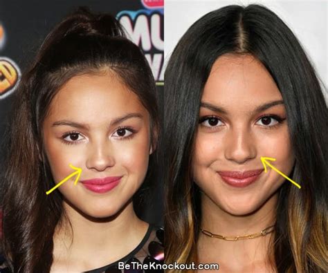 Olivia Rodrigo Plastic Surgery Comparison Photos