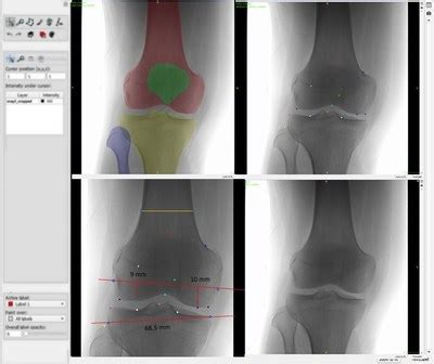 RSIP Vision Launches A New Knee Segmentation And Landmark Detection