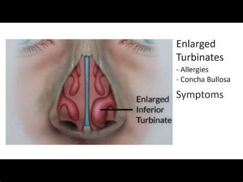 Enlarged Nasal Turbinates Symptoms and Treatment | FunnyCat.TV