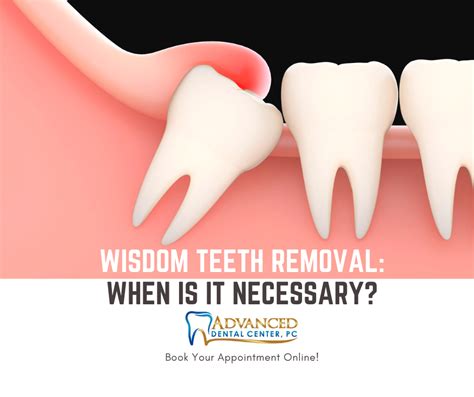 Wisdom Teeth Removal When Is It Necessary