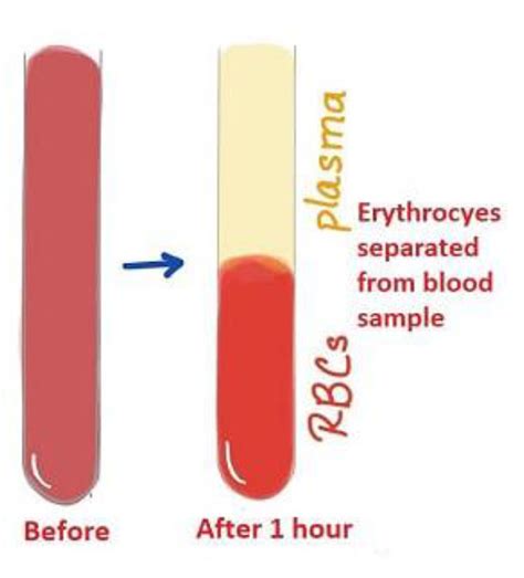 Esr Erythrocyte Sedimentation Rate Focus Dentistry