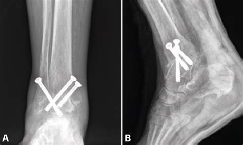 Artrodesis Tibiotalar Abierta Indicaciones Y T Cnica Quir Rgica