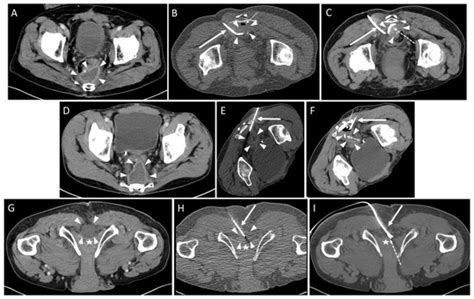 Diagnostics Free Full Text Low Dose CT Fluoroscopy Guided Drainage