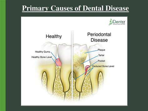 Ppt Primary Causes Of Dental Disease Powerpoint Presentation Free