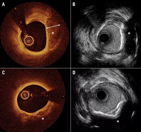 Intracoronary Optical Coherence Tomography State Of The Art And Future