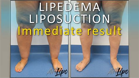 Lipo Lipedema