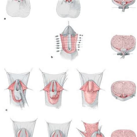 Pdf Hypospadias Surgery An Illustrated Guide