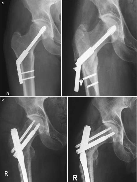 Pertrochanteric Fractures Musculoskeletal Key