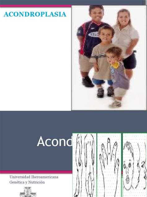 B Acondroplasia Pdf Enfermedades Y Trastornos Medicina Clinica