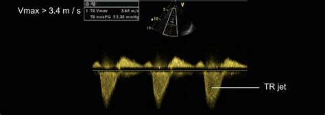 echo basics mitral regurgitation litfl radiology library