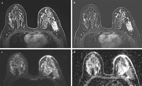 Same Patient A Post Contrast T1 Weighted Axial Image Shows High