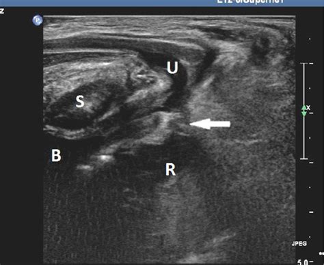 Figure 1 From Usefulness Of Transperineal Ultrasonography TPUS In