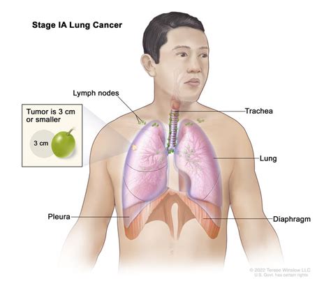 Non Small Cell Lung Cancer Treatment Pdq® Nci