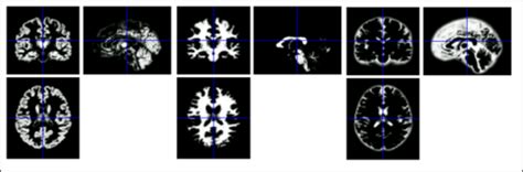 Neuroimaging Flashcards Quizlet