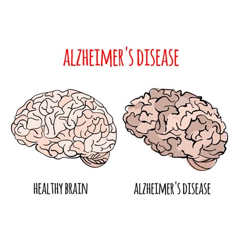 Choroba Alzheimera Objawy Fazy Opieka Pomocna D O