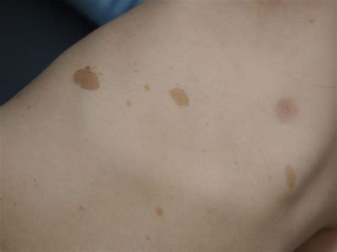 Acd A Z Of Skin Café Au Lait Macules
