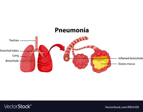 Diagram Showing Lung With Pneumonia Royalty Free Vector Hot Sex