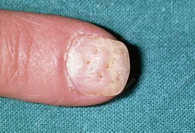 Psoriasis: pitting of a fingernail - Stock Image - M240/0122 - Science ...