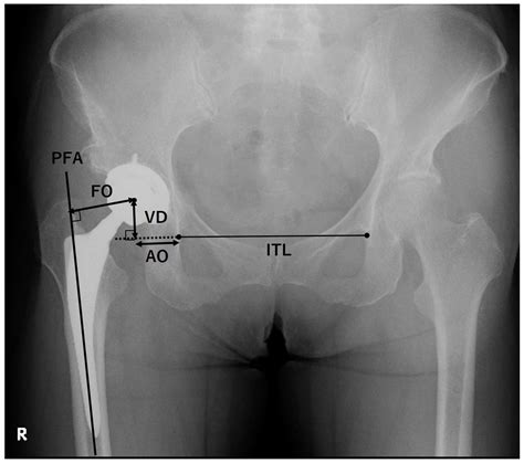 Jcm Free Full Text Clinical Outcomes For Total Hip Arthroplasty With And Without Previous