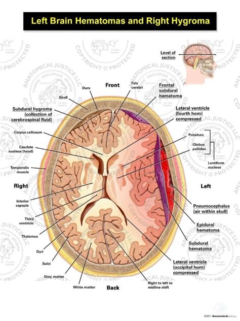 Female Left Craniotomy With Evacuation Of Subdural And Epidural