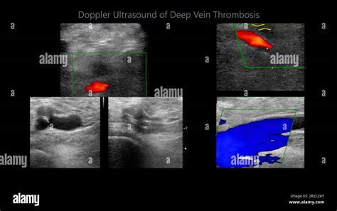 Color Doppler Ultrasound Determination In Deep Vein Thrombosis Patients