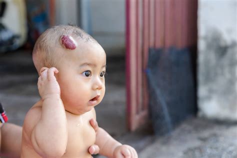 Strawberry Hemangiomas Birth Marks Causes And When To Consult A