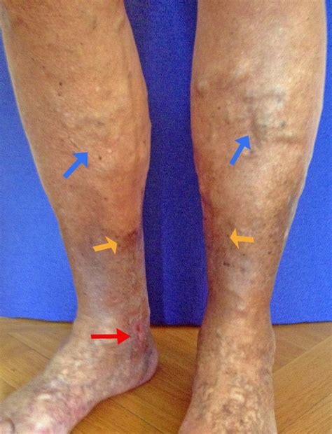 Ulcus Cruris Braunverfaerbung Krampfader VENENZENTRUM