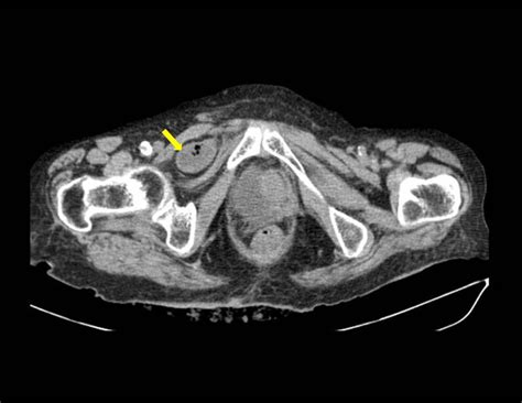 American Journal Of Case Reports Small Bowel Obstruction Due To