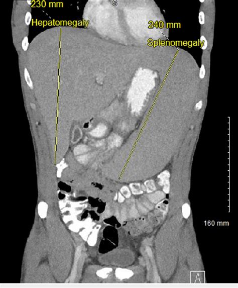 Contrast Enhanced Ct Abdomen And Pelvis Coronal View Demonstrating