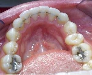 fixed retainers – My Invisalign Blog