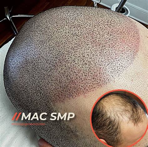 The Stages Of Hair Loss Hair Loss Myths Debunked