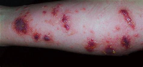 poison ivy rashes and blisters - Gallery | eBaum's World