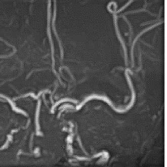 A Axial Head CT Scan Revealed A Subarachnoid Hemorrhage Fisher Grade