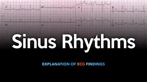 Sinus Rhythm Ecg Explained Youtube