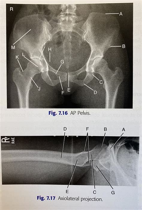 Ap Pelvis And Axiolateral Projection Radiographs Diagram Quizlet