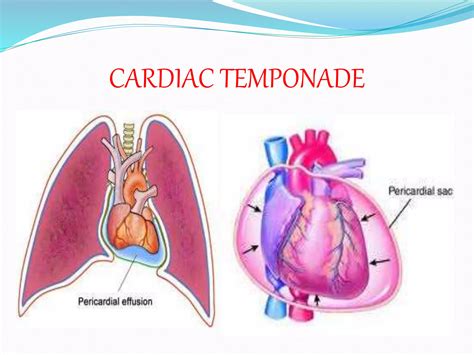 Cardiac Emergencies Ppt