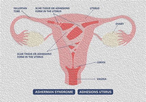 Endometrial Scarringadhesions Ashermans Syndrome Dr Eleftherios