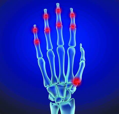 Osteoarthritis in Hands - Arthritis Advisor