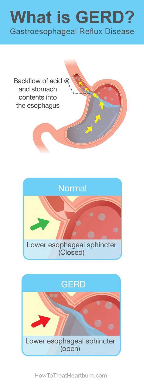 Gerd symptoms