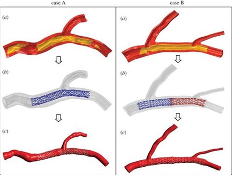 Computational Fluid Dynamic Simulations Of Image Based Stented Coronary