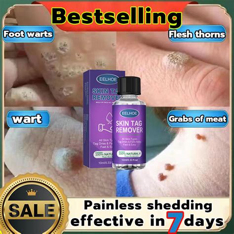 100 Effective Wart Removal Cream 10g Painless Face And Neck Wart