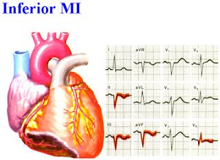 inferior st elevation myocardial infarction ina ecg