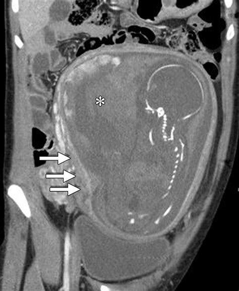 Imaging Of Trauma In The Pregnant Patient Radiographics