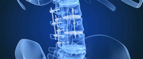 What Is A Peek Spinal Cage Genesis Medical Plastics