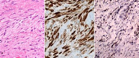 Periosteal Desmoplastic Fibroma Of Radius A Rare Bone Tumor Apsp