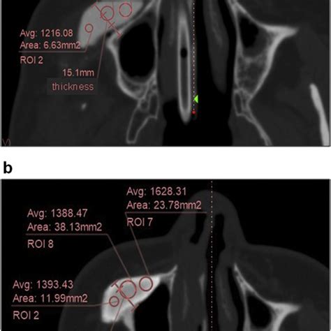 Interior CT Values Of The CT Bones The CT Values And The Thickness