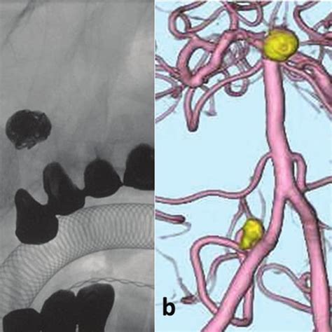 A Intraoperative Angiography Of The Vertebral Artery B