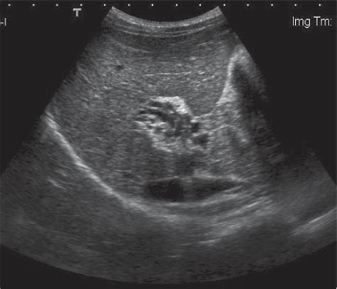 Liver Portal Venous System And Hepatic Veins Radiology Key